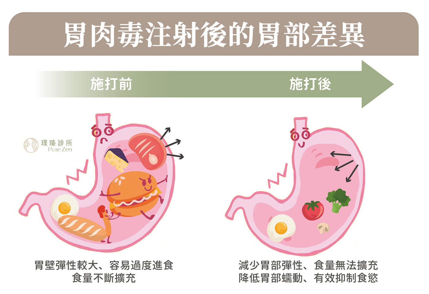 什麼是胃肉毒注射：胃肉毒減重採舒眠胃鏡技術，胃內肉毒注射後約1~3週逐漸感受到食慾下降，可減少胃部彈性、食量無法擴充、降低胃部蠕動、有效抑制食慾，延長飽腹感的時間約可達4~6個月，並改變體內的食慾荷爾蒙分泌，進而達到體重下降的效果。