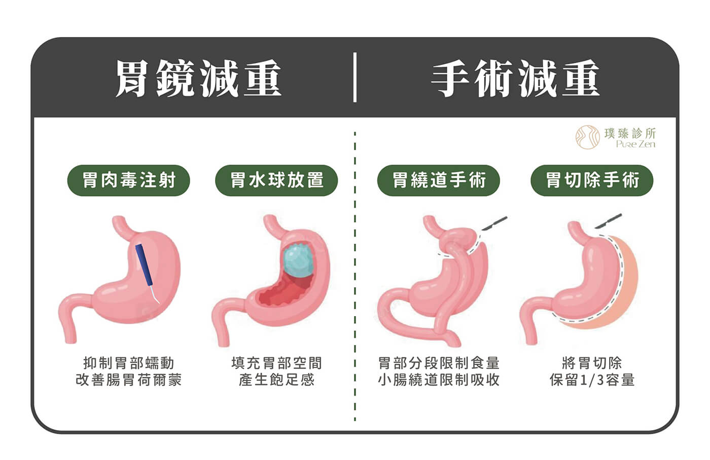 常見胃部減重手術療程差異，全球肥胖率不斷升高，輔佐減肥的技術也日新月異，目前已有多種胃部的減重及代謝手術，璞臻診所特別列出常見之內外科「胃部減重療程(胃肉毒注射、胃水球放置、胃縫合治療、胃繞道手術、胃切除手術)」，幫您彙整各個療程的優缺點及差異性，作為與專業醫師諮詢時的溝通參考。