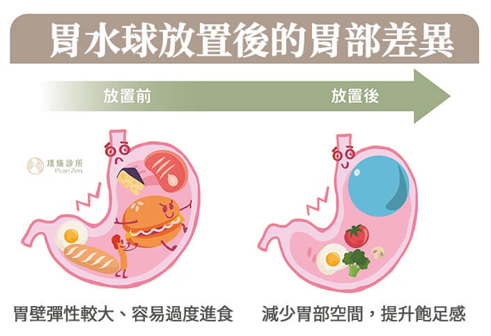 胃水球放置後的胃部差異，胃水球放置前胃壁彈性較大、容易過度進食、食量不斷擴充；胃水球放置後，減少胃部空間，提升飽足感、延長胃排空、有效抑制食慾，達到飲食控制目標。