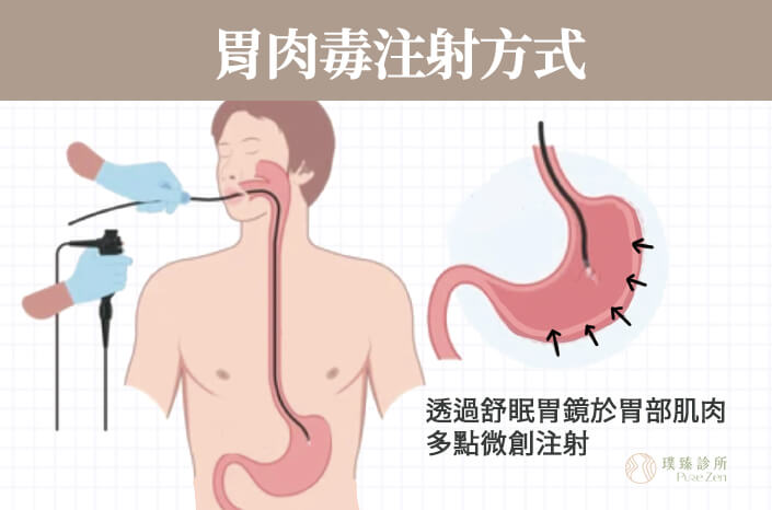 什麼是胃肉毒注射：胃內肉毒桿菌注射，又稱胃肉毒減重、胃鏡減重、縮胃針。透過胃鏡將帶有鏡頭及注射器的軟管，通過喉嚨進入食道，於胃部平滑肌多點微創注射肉毒桿菌素。